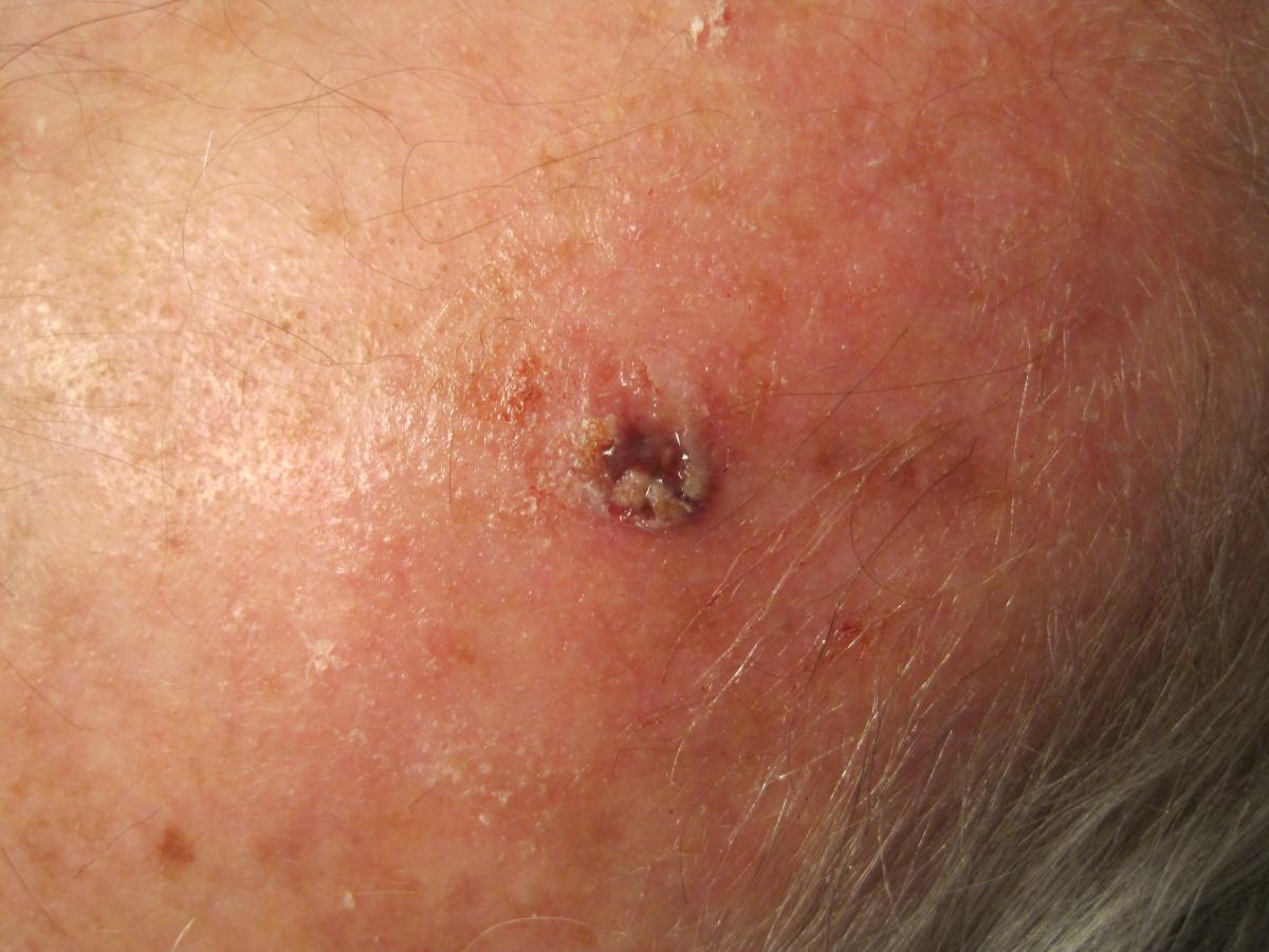 basal cell carcinoma removal 1
