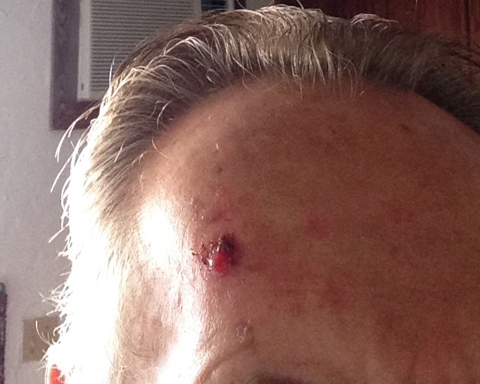 Picture of Basal Cell Carcinoma, Natural Cure