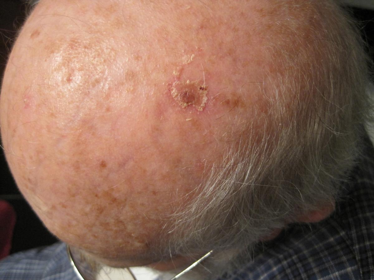basal cell carcinoma removal 5