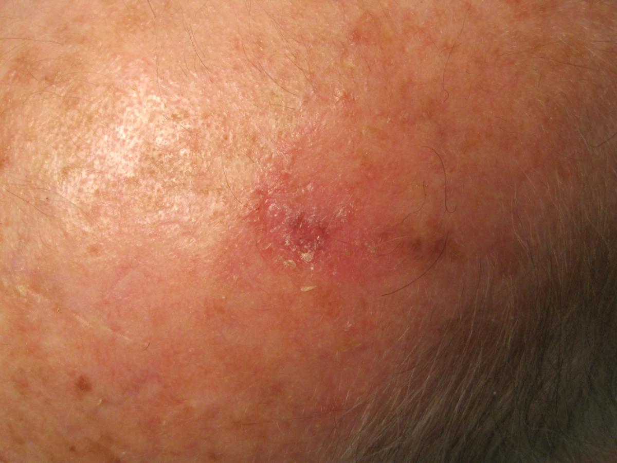 basal cell carcinoma removal 6