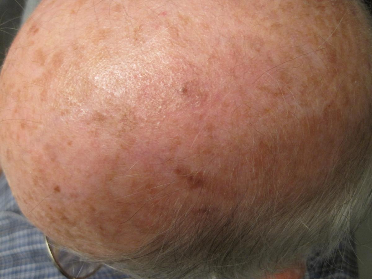 basal cell carcinoma removal final