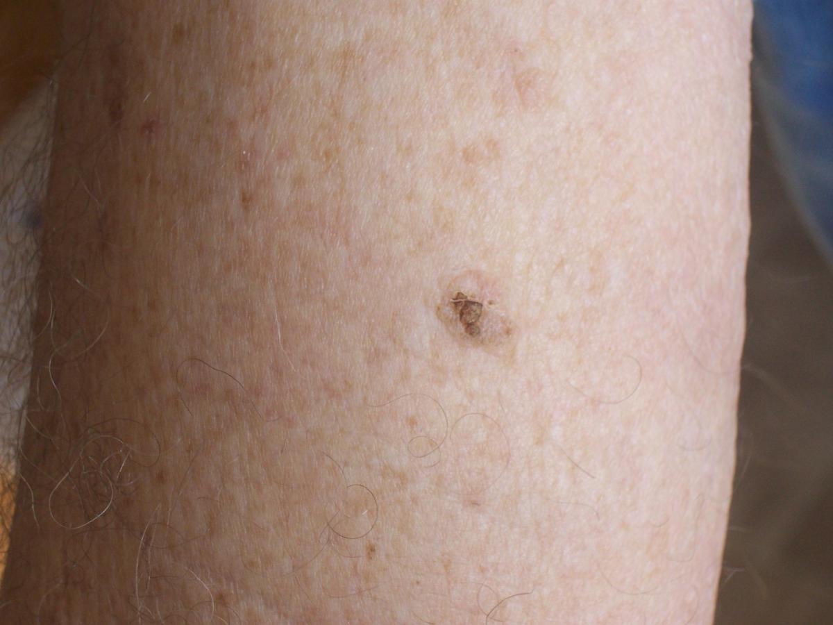 removing mole on arm with perrin's blend 2