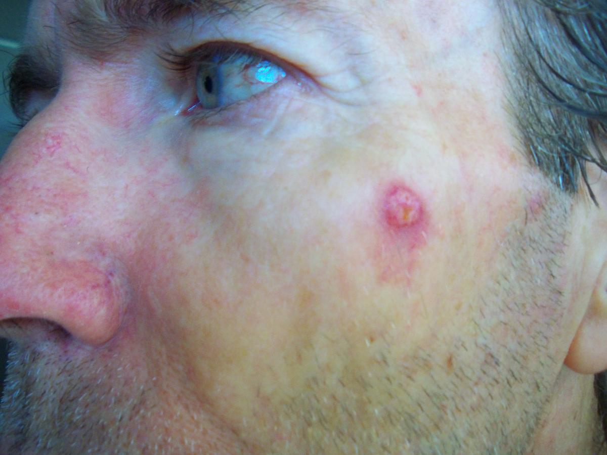 Skin Cancer on face. Natural Treatment for Basal Cell Carcinoma