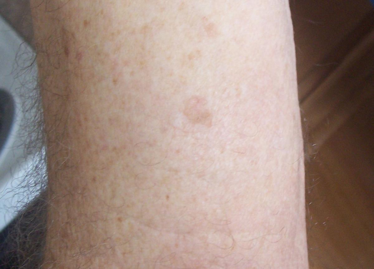 naturally removing mole on arm 3